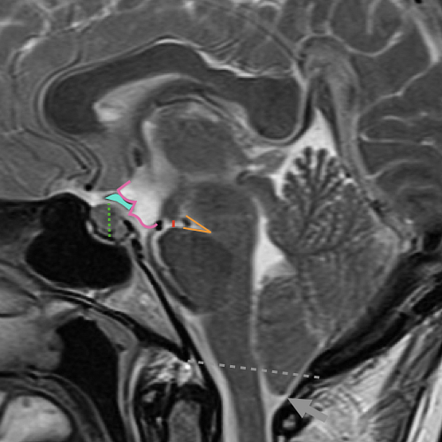 Intracranial Hypotension Image Radiopaedia Org