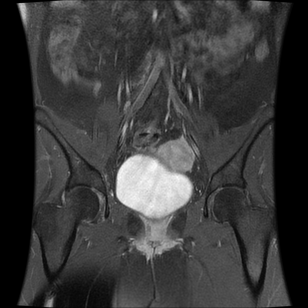 Adult Granulosa Cell Tumor Of The Ovary Image Radiopaedia Org