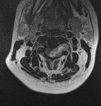 Spinal Schwannoma Cervical Image Radiopaedia Org