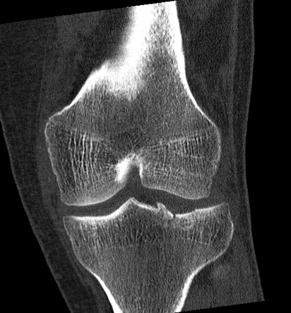 Schatzker Classification Of Tibial Plateau Fractures Radiology