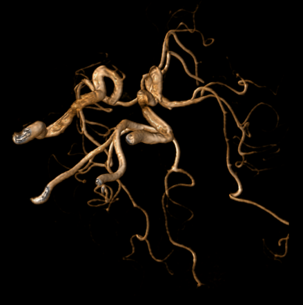 Circle Of Willis Image Radiopaedia Org