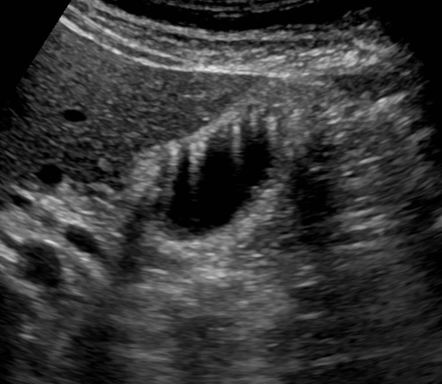 Gallbladder Adenomyomatosis Radiology Case Radiopaedia Org