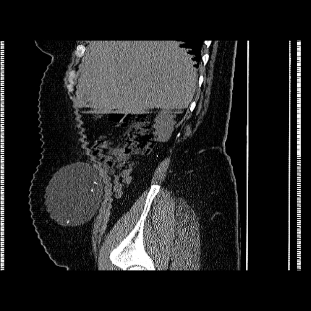 Abdominal Wall Pseudocyst Complicating A Lumboperitoneal Shunt Image