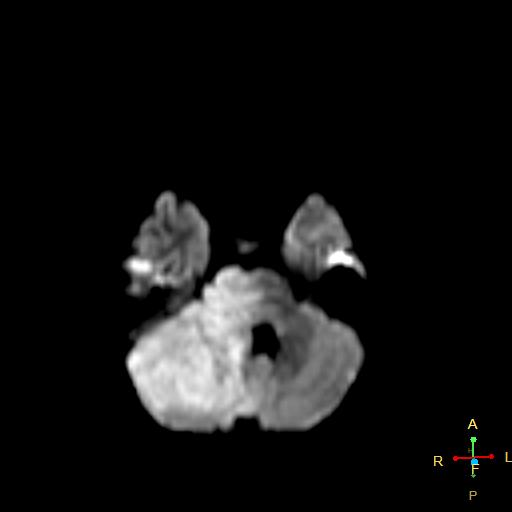 Malignant Degeneration Of Low Grade Glioma Image Radiopaedia Org