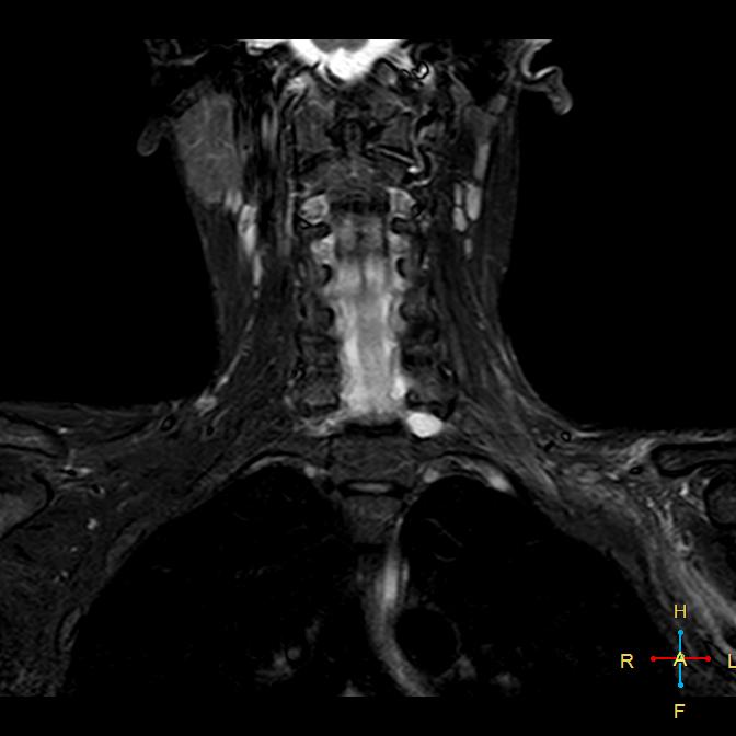 Traumatic Brachial Plexus Injury Image Radiopaedia Org