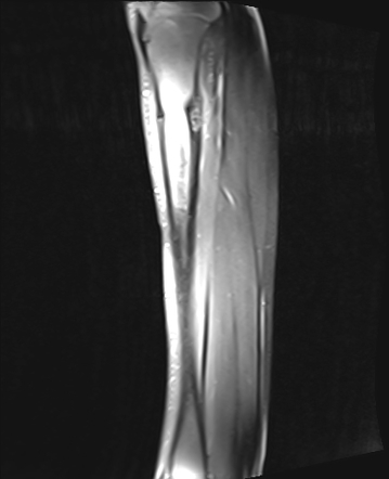 Osteoblastoma Image Radiopaedia Org