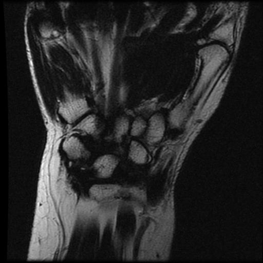 De Quervain Tenosynovitis Image Radiopaedia Org