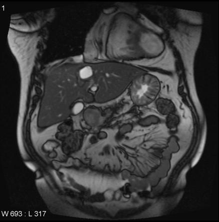 Hepatic Hydatid Cyst Image Radiopaedia Org