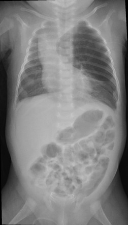 Congenital Lobar Overinflation Radiology Reference Article