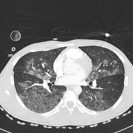 Near Drowning Pulmonary Edema Radiology Reference Article Radiopaedia Org