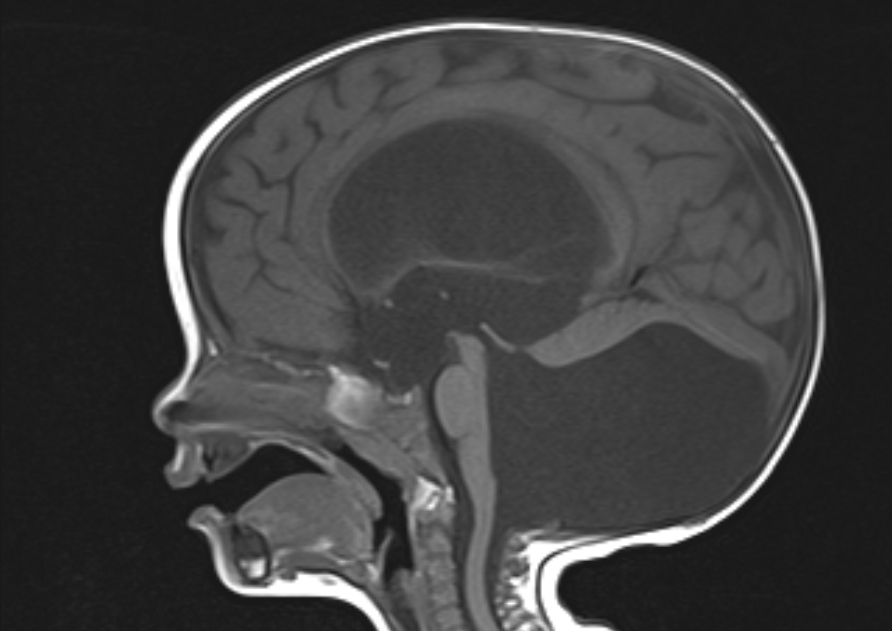 Dandy Walker Malformation Image Radiopaedia Org