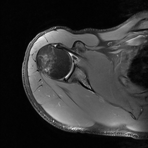 Bankart Lesion With Hill Sachs Lesion Image Radiopaedia Org