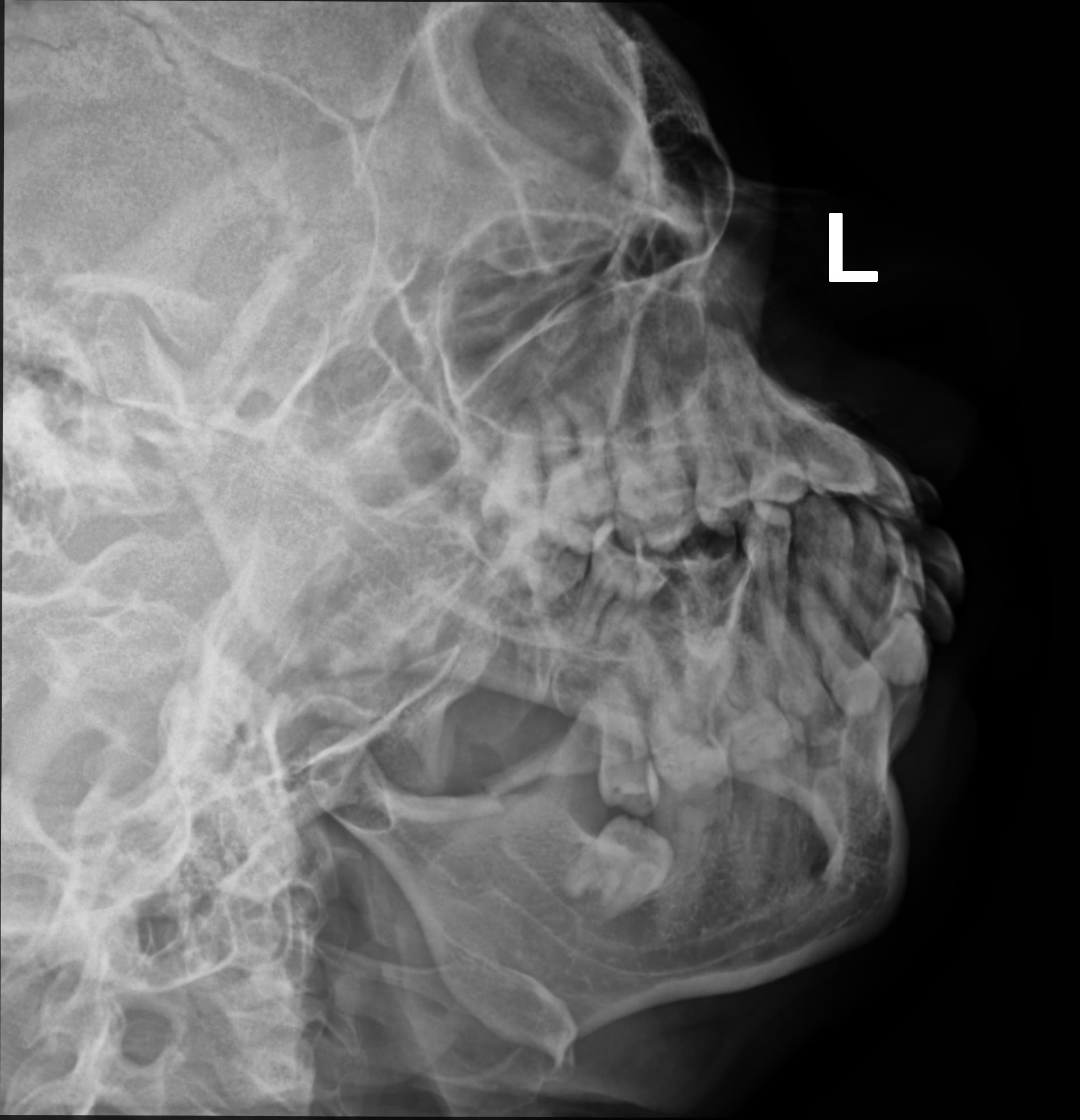 Mandibular Ramus Fracture Image Radiopaedia Org