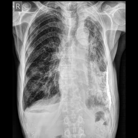 Pleural Calcification With Tuberculosis Radiology Case Radiopaedia Org