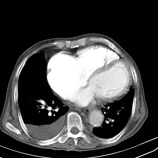 Congestive Cardiac Failure CT Image Radiopaedia Org