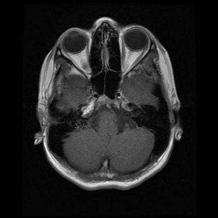 Cerebellopontine Angle Arachnoid Cyst Image Radiopaedia Org