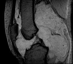 Pigmented Villonodular Synovitis Knee Image Radiopaedia Org