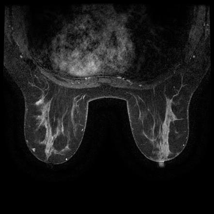 Intraductal Papilloma Breast MRI Image Radiopaedia Org