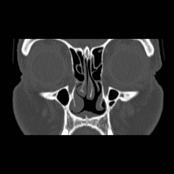 Nasal Septal Perforation Image Radiopaedia Org