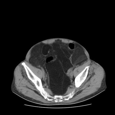 Diffuse Intrabdominal Lipomatosis Radiology Case Radiopaedia Org