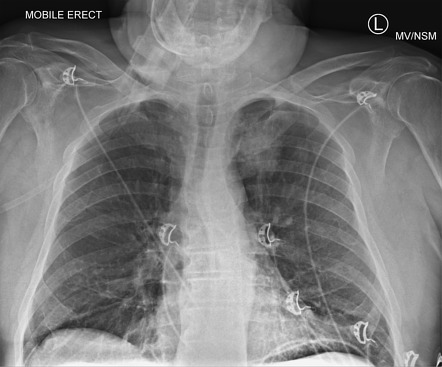 Left Apical Lung Cancer Radiology Case Radiopaedia Org