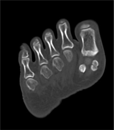 Bipartite Medial Hallux Sesamoid With Sesamoiditis Image