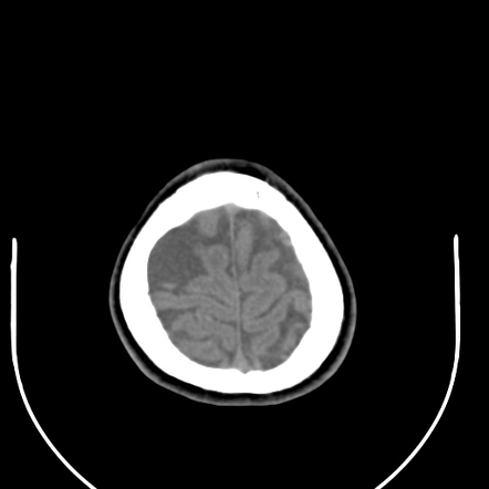 Arachnoid Cyst Radiology Case Radiopaedia Org