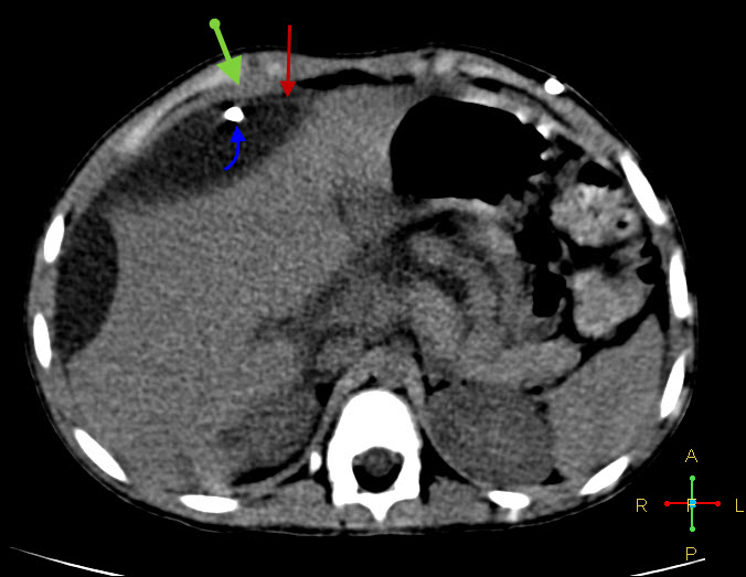 Hepatic Subcapsular CSF Pseudocyst Image Radiopaedia Org