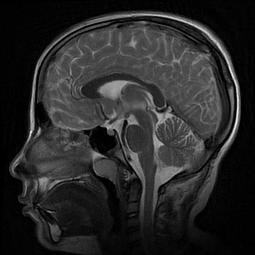 Arachnoid Cyst Middle Cranial Fossa Image Radiopaedia Org