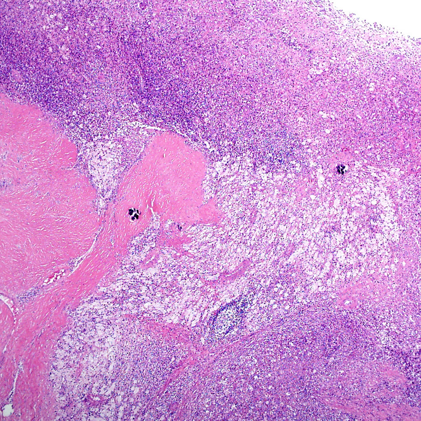 Xanthogranulomatous Pyelonephritis Gross Pathology Image