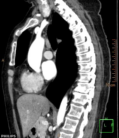 Morgagni Hernia Image Radiopaedia Org