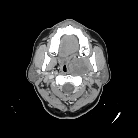 Vagal Schwannoma Image Radiopaedia Org