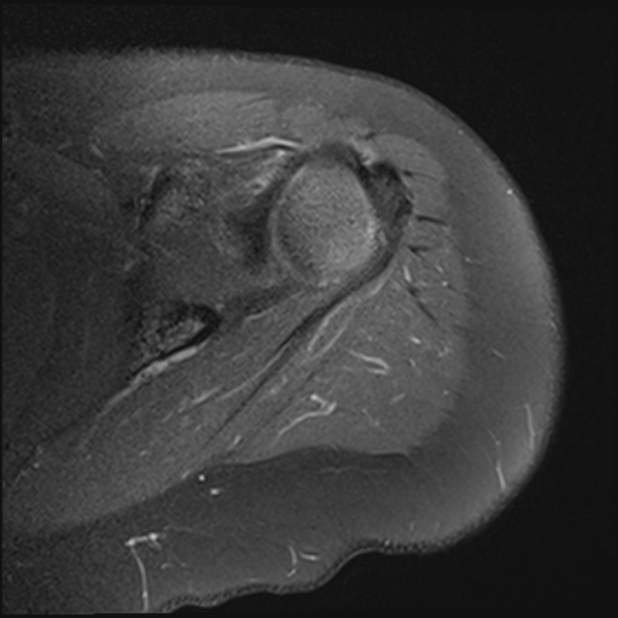 Supraspinatus Tendon Calcification Sexiz Pix