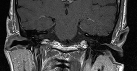 Trigeminal Neuralgia Vascular Compression Image Radiopaedia Org