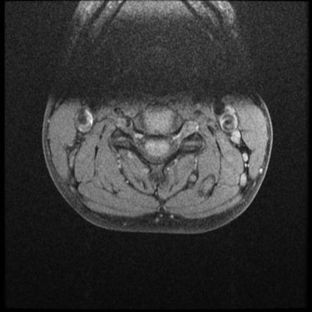 Vertebral Artery Dissection Radiology Reference Article Radiopaedia Org