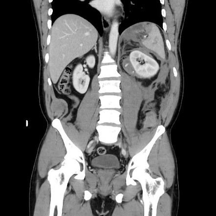 Blunt Abdominal Trauma With Solid Organ And Musculoskelatal Injury With