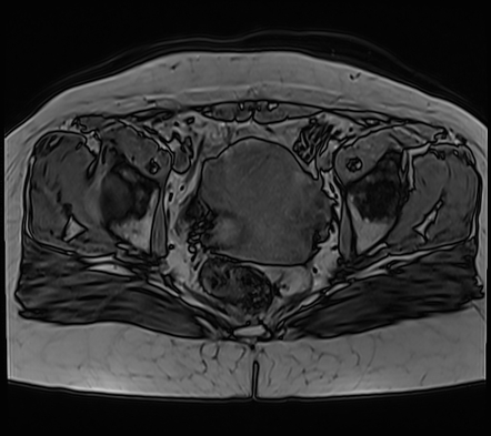 Ovarian Endometrioma Image Radiopaedia Org