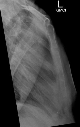 Sternal Fracture Radiology Case Radiopaedia Org