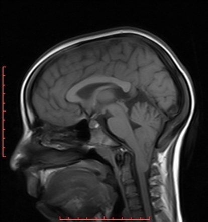 Chiari Malformation Radiology Reference Article Radiopaedia Org