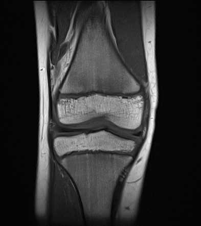 Posterior Cruciate Ligament Rupture Image Radiopaedia Org