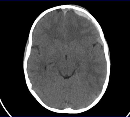 Subdural Hemorrhage Radiology Reference Article Radiopaedia Org