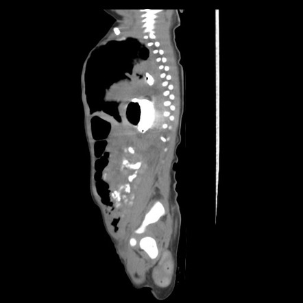 Congenital Diaphragmatic And Perineal Hernias Radiology Case