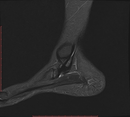 Accessory Navicular Syndrome Image Radiopaedia Org