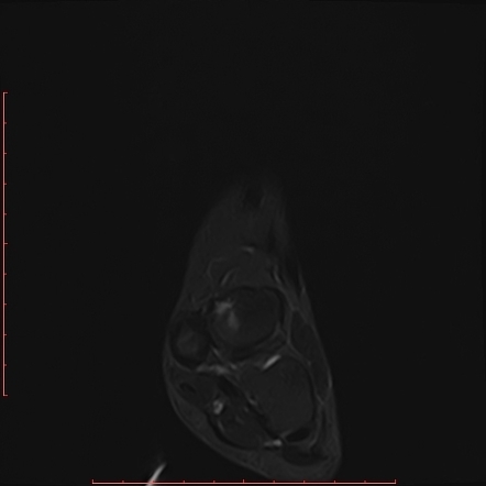 Accessory Navicular Syndrome Image Radiopaedia Org