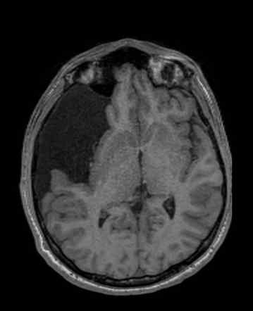 Arachnoid Cyst Extremely Large Image Radiopaedia Org