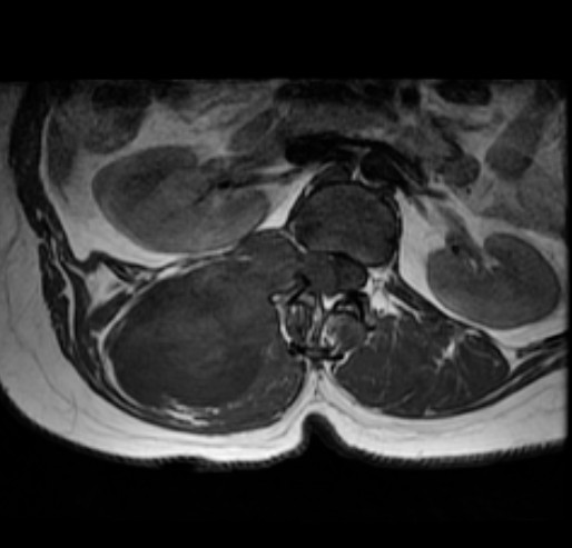 Spinal Schwannoma Image Radiopaedia Org