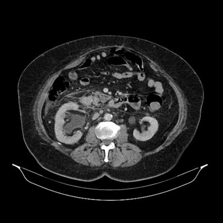 Acute Pyelonephritis Radiology Case Radiopaedia Org