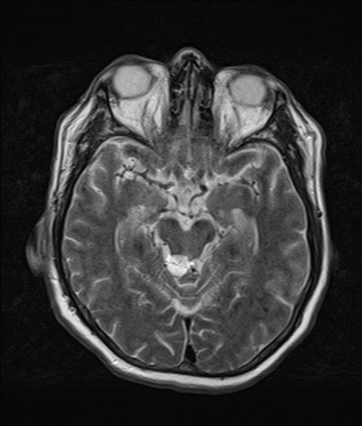 Quadrigeminal Cistern Lipoma Image Radiopaedia Org