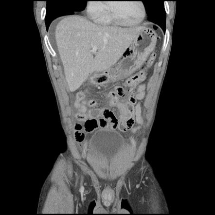 Perforated Gastric Ulcer Radiology Case Radiopaedia Org