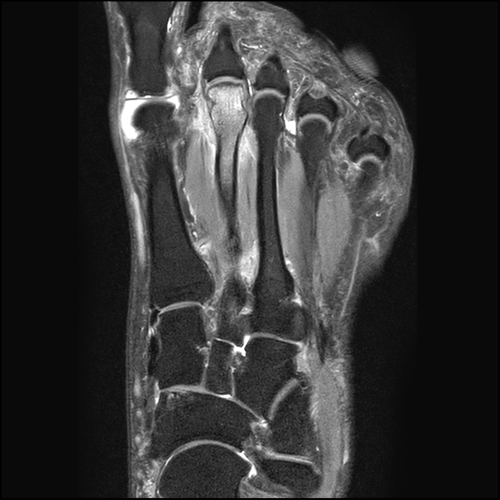 Metatarsal Fatigue And Insufficiency Stress Fractures Image